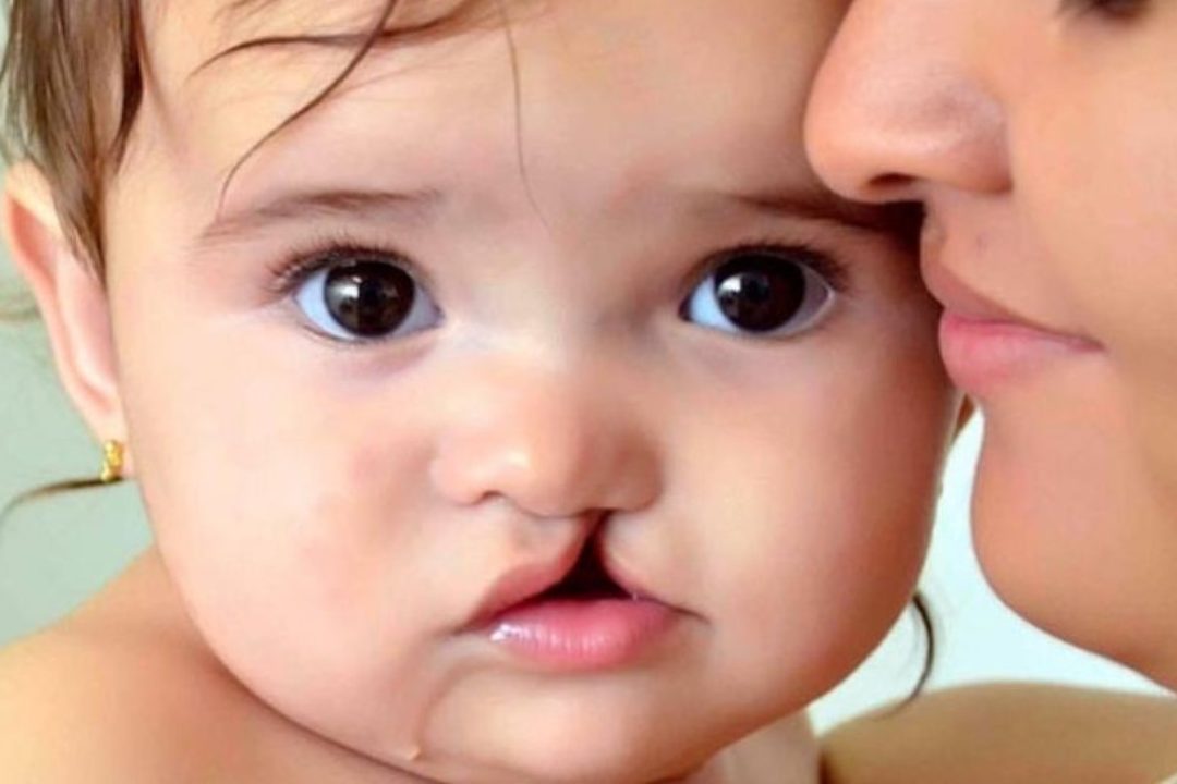 Labio leporino: ¿cómo corregir en niños?