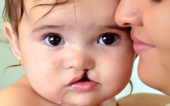 Labio leporino: ¿cómo corregir en niños?