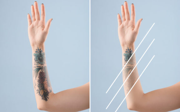 ¿Qué debes saber sobre la eliminación de tatuajes?