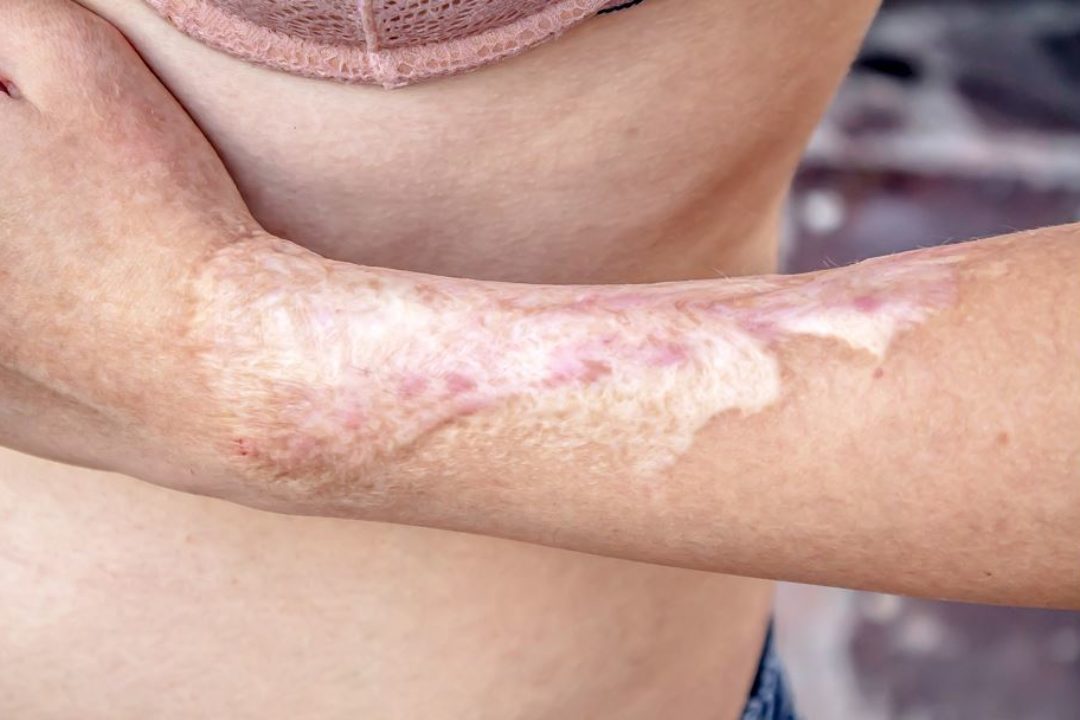 Conoce más sobre la Cirugía Plástica Reconstructiva